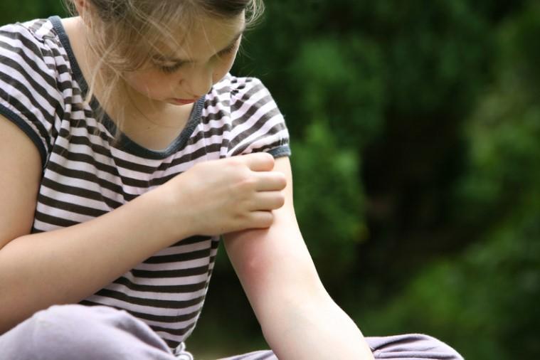 Jak na bolestivé štípance od komárů? Postačí brambor nebo máta