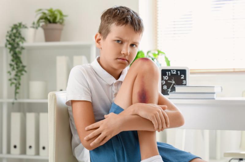 Dětské úrazy v létě: Jak správně ošetřit modřiny a předcházet jim