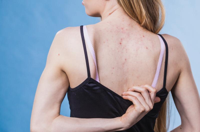Nejen obličej: Jak se zbavit akné na zádech, ramenou a hrudníku jednou provždy?